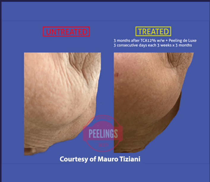 anti aging skin peeling