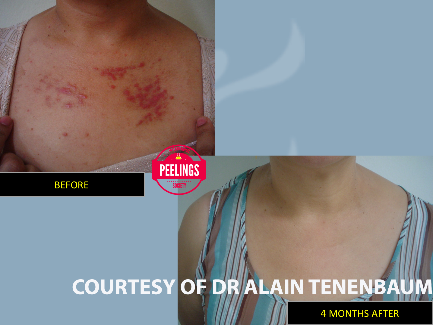 SUPERFICIAL HYPERCHROMY PEEL DECOLETE