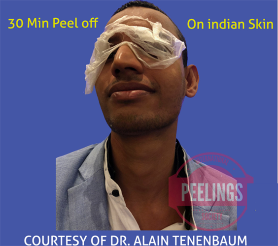 peeling for indian skin
