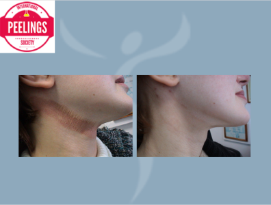 peel post complication