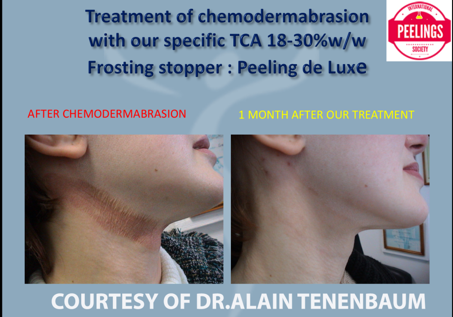 post chemodermabrasion